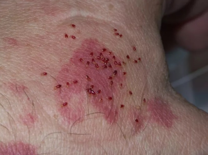 ����!����Bed bug���ĳ��� ��ҧ��ʹ�����,��Щ����һ��С��